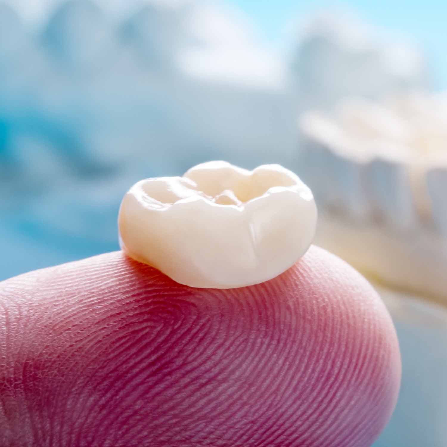 How Long Do Dental Crowns Last?